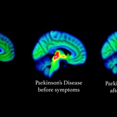 Parkinson's Disease